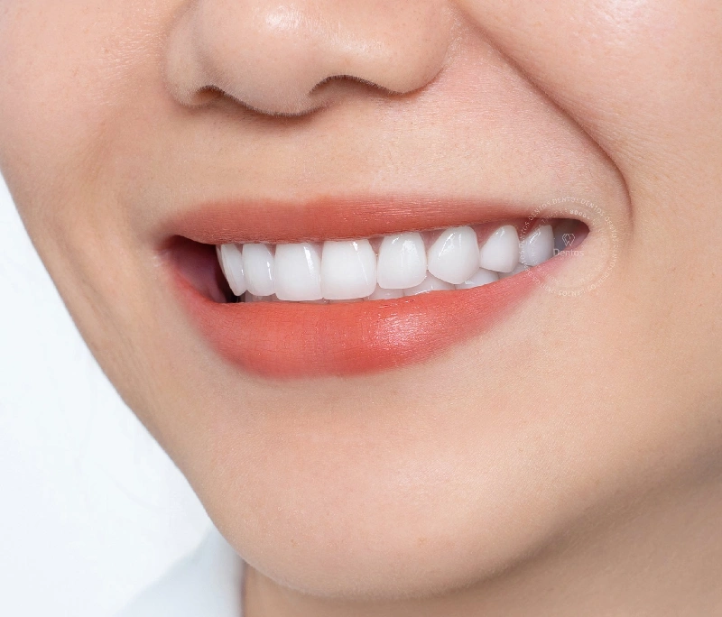 Bật mí 4 lý do tại sao phải bọc răng sứ thẩm mỹ